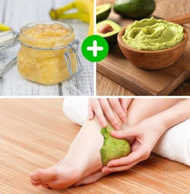 trị gót chân nứt đen bằng hỗn hợp bơ chuối